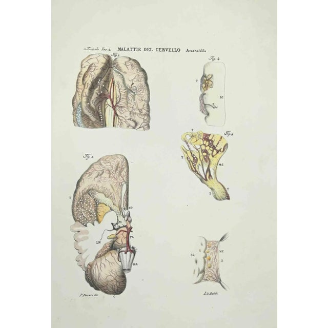 Brain Diseases is a lithograph hand colored by Ottavio Muzzi for the edition of Antoine Chazal, Human Anatomy, Printers...