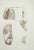 Brain Diseases is a lithograph hand colored by Ottavio Muzzi for the edition of Antoine Chazal, Human Anatomy, Printers...
