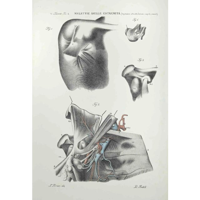 Diseases of the Extremities is a lithograph hand colored by Ottavio Muzzi for the edition of Antoine Chazal, Human...