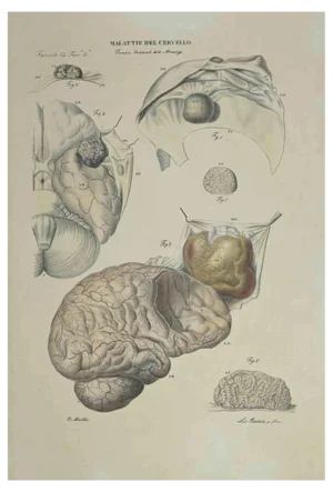 Ottavio Muzzi, Brain Diseases, Lithograph, 1843