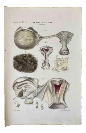 Ottavio Muzzi, Diseases of the Ovary, Lithograph, 1843