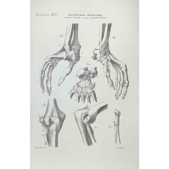 Joint Diseases is a lithograph hand colored by Ottavio Muzzi for the edition of Antoine Chazal, Human Anatomy, Printers...