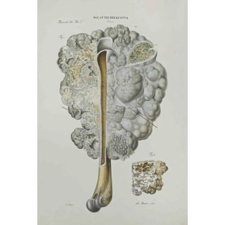 Ottavio Muzzi, Bone Disease, Lithograph, 1843 For Sale