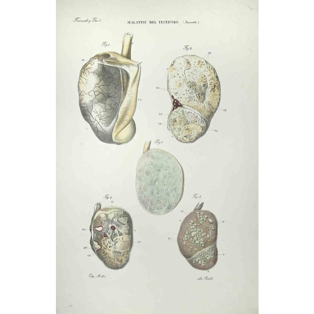 Testicular Diseases is a lithograph hand colored by Ottavio Muzzi for the edition of Antoine Chazal, Human Anatomy,...