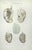 Testicular Diseases is a lithograph hand colored by Ottavio Muzzi for the edition of Antoine Chazal, Human Anatomy,...
