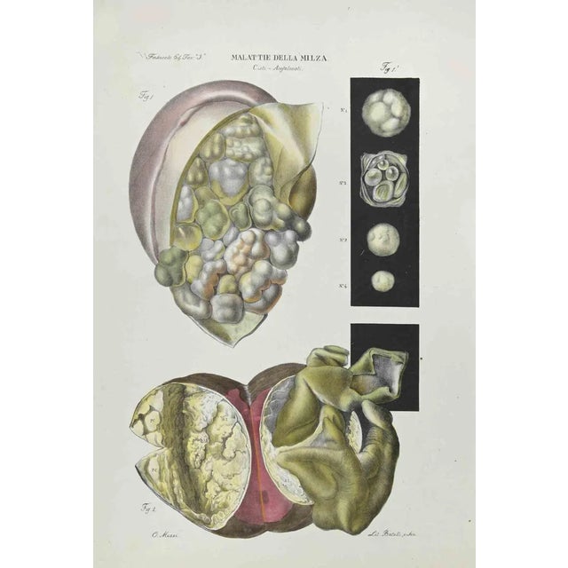 Ottavio Muzzi, Diseases of the Spleen, Lithograph, 1843 For Sale