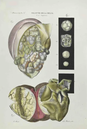 Ottavio Muzzi, Diseases of the Spleen, Lithograph, 1843