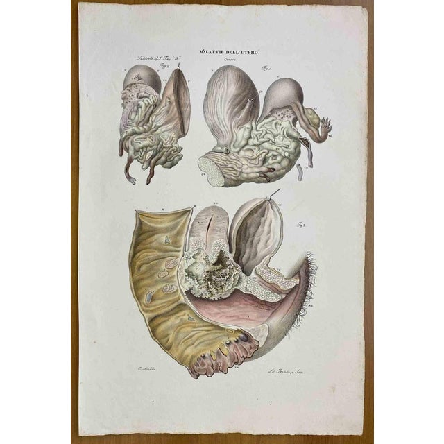 Diseases of Uterus is a lithograph hand colored by Ottavio Muzzi for the edition of Antoine Chazal, Human Anatomy,...