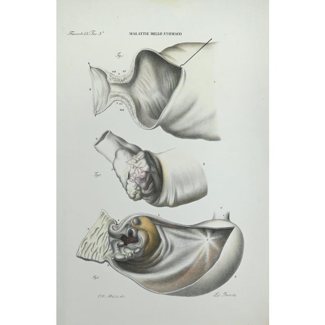 Stomach Diseases is a lithograph hand colored by Ottavio Muzzi for the edition of Antoine Chazal,Human Anatomy, Printers...