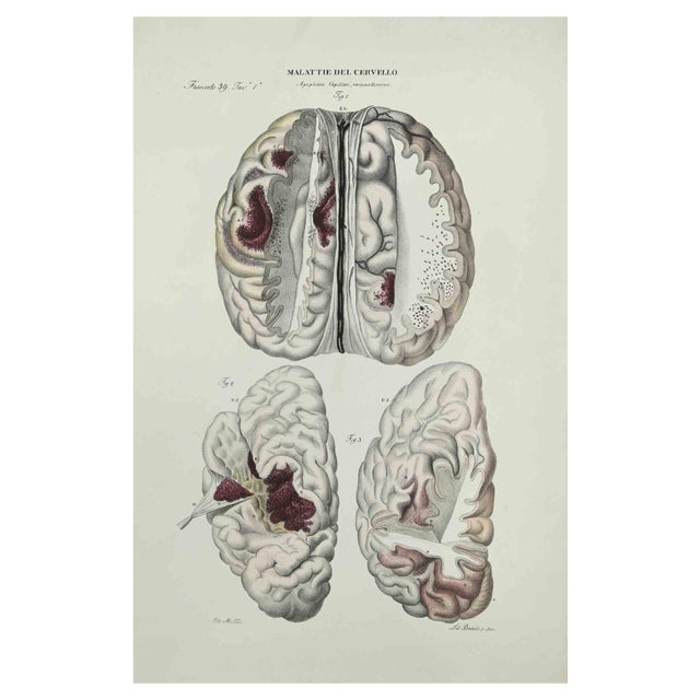 Ottavio Muzzi, Brain Diseases, Lithograph, 1843 For Sale