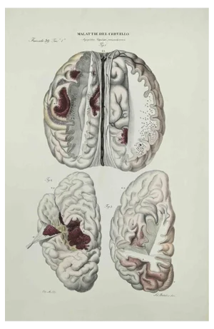 Ottavio Muzzi, Brain Diseases, Lithograph, 1843