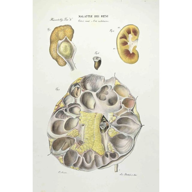 Kidney Diseases is a lithograph hand colored by Ottavio Muzzi for the edition of Antoine Chazal,Human Anatomy, Printers...