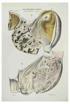 Ottavio Muzzi, Stomach Diseases, Lithograph, 1843