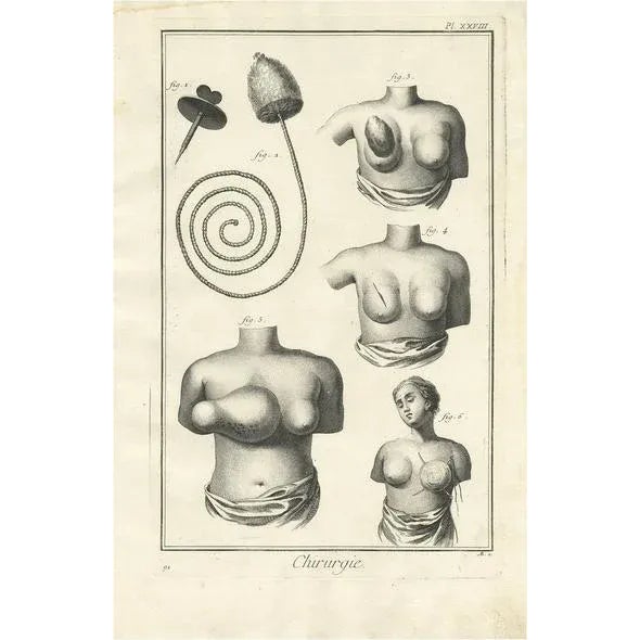Diderot, Medical Print Pl. XXVIII, 1760, Print For Sale - Image 5 of 5