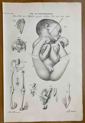 Ottavio Muzzi, Conformation Defects, Lithograph, 1843