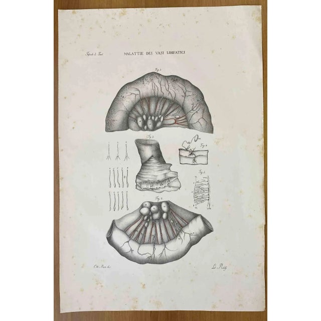 Diseases of the Lymphatic Vessels is a lithograph hand colored by Ottavio Muzzi for the edition of Antoine Chazal, Human...