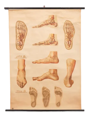 Vintage Pull-Down Medical Wall Chart Illustrating Orthopedics of Foot, 1935
