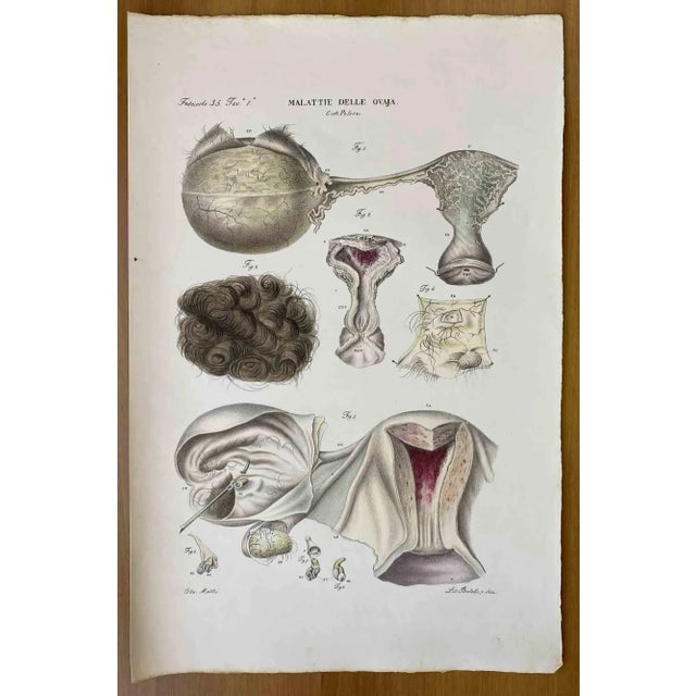 Diseases of the Ovary is a lithograph hand colored by Ottavio Muzzi for the edition of Antoine Chazal, Human Anatomy,...