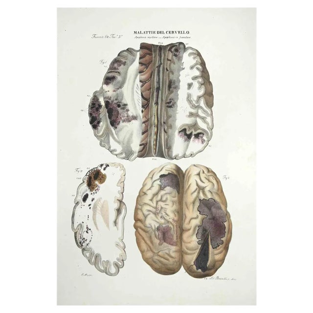 Ottavio Muzzi, Brain Diseases, Lithograph, 1843 For Sale