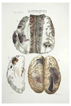 Ottavio Muzzi, Brain Diseases, Lithograph, 1843