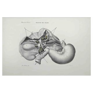 Ottavio Muzzi, Liver Disease, Lithograph, 1843 For Sale