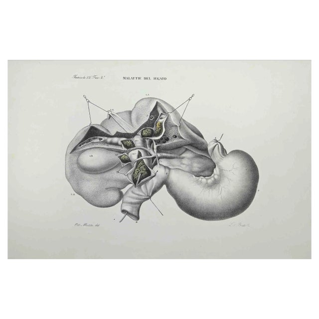Ottavio Muzzi, Liver Disease, Lithograph, 1843 For Sale