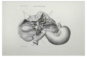 Ottavio Muzzi, Liver Disease, Lithograph, 1843