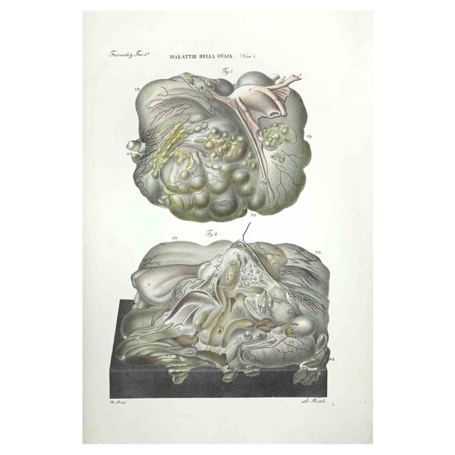 Ottavio Muzzi, Diseases of the Ovary, Lithograph, 1843 For Sale