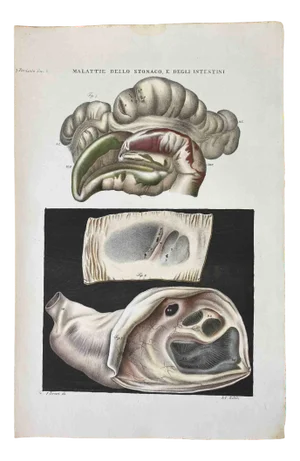 Ottavio Muzzi, Diseases of the Stomach and Intestines, Lithograph, 1843
