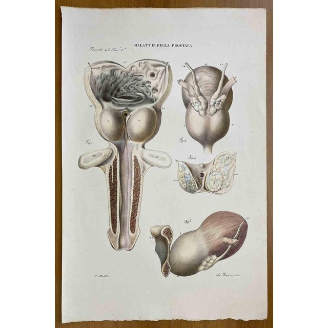 Prostate Diseases is a lithograph hand colored by Ottavio Muzzi for the edition of Antoine Chazal, Human Anatomy, Printers...