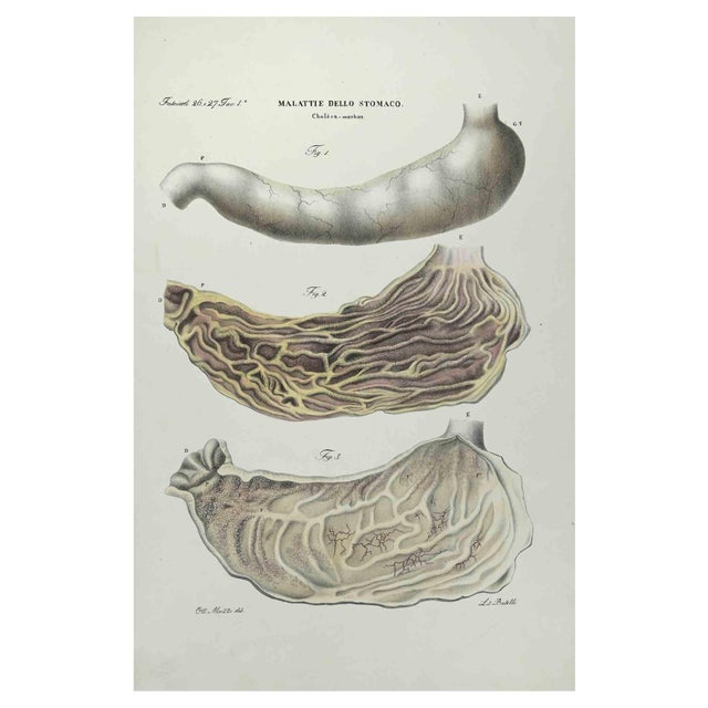 Ottavio Muzzi, Stomach Diseases, Lithograph, 1843 For Sale
