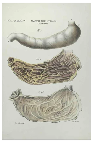 Ottavio Muzzi, Stomach Diseases, Lithograph, 1843