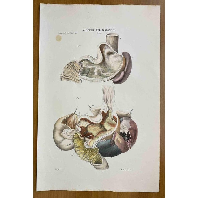Stomach Diseases is a lithograph hand colored by Ottavio Muzzi for the edition of Antoine Chazal, Human Anatomy, Printers...