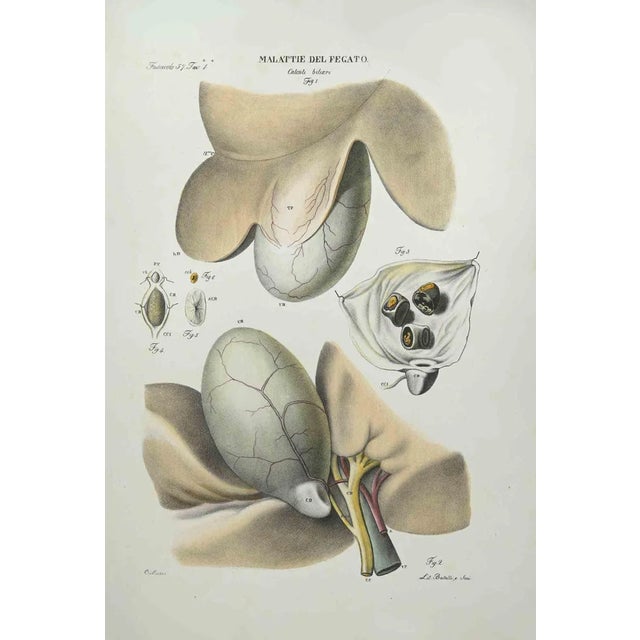 Ottavio Muzzi, Liver Disease, Lithograph, 1843 For Sale