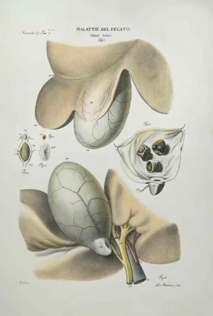 Ottavio Muzzi, Liver Disease, Lithograph, 1843