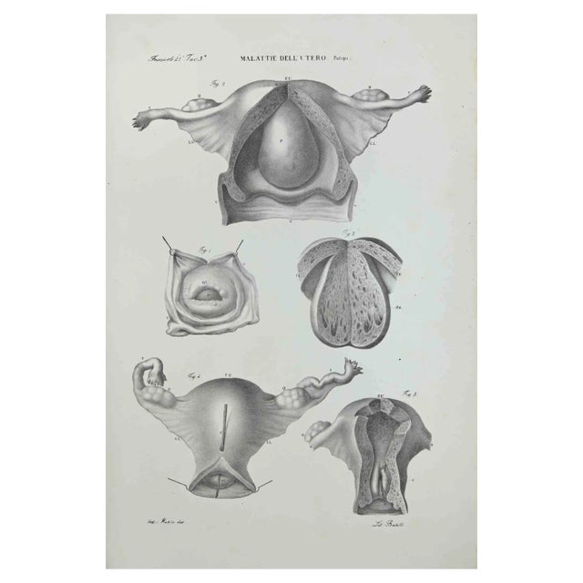 Ottavio Muzzi, Uterus Diseases, Lithograph, 1843 For Sale