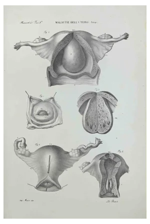 Ottavio Muzzi, Uterus Diseases, Lithograph, 1843