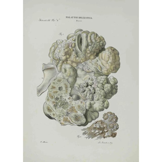 Ottavio Muzzi, Bone Disease, Lithograph, 1843 For Sale