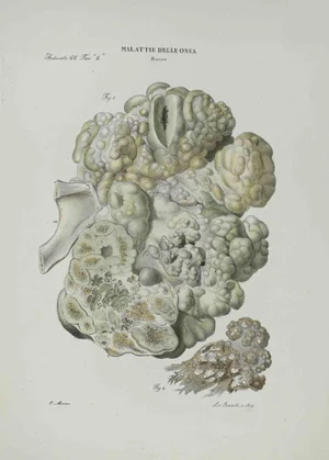 Ottavio Muzzi, Bone Disease, Lithograph, 1843
